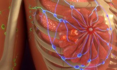 Thử nghiệm xóa sổ 'tế bào ngủ' gây tái phát ung thư vú