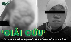 Giải cứu khuôn mặt cô gái sau 15 năm mang khối u khổng lồ