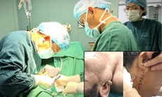 Hàm sưng to, cụ ông tái phát u tuyến nước bọt sau gần 10 năm
