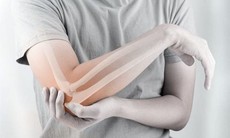 Loãng xương sớm - Dùng thuốc và phòng ngừa như thế nào?