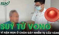 Suýt tử vong vì nặn mụn ở chân gây nhiễm tụ cầu vàng ăn vào cột sống 