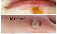 Bệnh chốc lở - Dùng thuốc nào để điều trị?