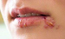 Vì sao zona thường tái phát và gây đau kéo dài?