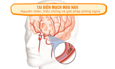 Tai biến mạch máu não: Nguyên nhân, triệu chứng và giải pháp phòng ngừa