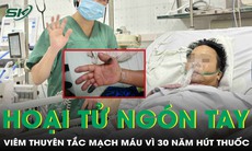 Viêm thuyên tắc mạch máu, loét đầu ngón tay hoại tử vì 30 năm hút thuốc lá
