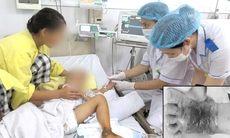 Bà đắp thuốc nam cho cháu bị mèo cắn, cả bàn chân hoại tử