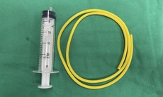 Nam thanh niên tự nhét ống cao su dài khoảng 1m vào bàng quang