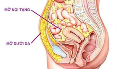 6 điều bạn nên làm để giảm mỡ nội tạng hiệu quả, bền vững