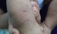 7 cách phòng bệnh tay chân miệng ở trẻ em