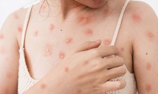 Cảnh báo thủy đậu ở người lớn có thể gây biến chứng nguy hiểm