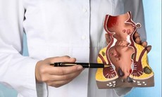 Trĩ nội độ 2 có cần mổ không?