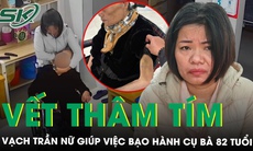 Vết thâm tím vạch trần hành vi độc ác của nữ giúp việc bạo hành cụ bà 82 tuổi ở Hà Nội