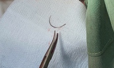 Kim khâu 'mắc kẹt' 11 năm ở tầng sinh môn của bệnh nhân