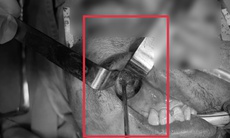 Nấm đen 'ăn' mòn xoang hàm người đàn ông khỏe mạnh