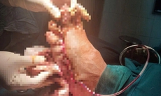 Người đàn ông suýt mất bàn chân vì máy cắt cỏ