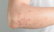 Nhiều trường hợp ở Khánh Hòa bị giun đũa chó mèo, người dân chủ động phòng bệnh