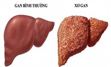 Dấu hiệu cảnh báo xơ gan không thể bỏ qua
