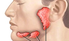 Sưng đau dưới lưỡi, cảnh giác với sỏi tuyến nước bọt