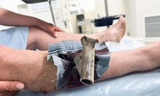 Chân chống xe máy găm cẳng chân, người đàn ông phải mang cả vào phòng cấp cứu