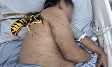 Người đàn ông 62 tuổi suýt chết vì bị ong đốt 300 nốt