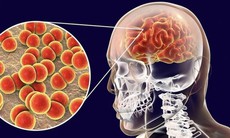Bệnh não mô cầu nguy hiểm thế nào, phòng bệnh ra sao?