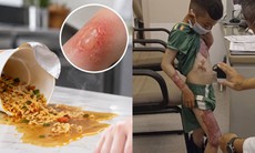 Bé 3 tuổi bị nước mì nóng đổ vào người, mẹ cứu con nhờ làm việc này