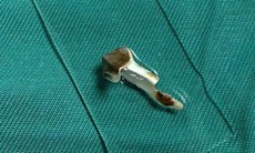 Bé 13 tuổi ho kéo dài hơn 3 năm, bác sĩ phát hiện dị vật nhựa trong phế quản