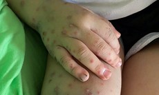 Ghi nhận hơn 1.800 ca tay chân miệng trong 1 tuần: Cảnh giác dấu hiệu bệnh chuyển nặng