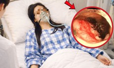 Nữ vận động viên 23 tuổi phát hiện ung thư đại tràng từ dấu hiệu đau bụng