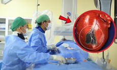 Người đàn ông 57 tuổi bất ngờ lên cơn nhồi máu cơ tim sau bữa tối