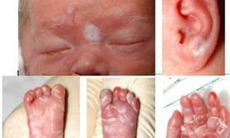 Bác sĩ chỉ cách phát hiện sớm và điều trị giang mai bẩm sinh