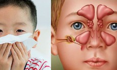 Biểu hiện thường gặp viêm mũi xoang ở trẻ