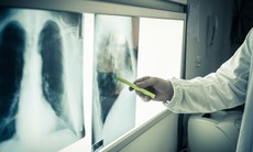 Bộ Y tế: Ưu tiên phân bổ ngân sách địa phương cho công tác phòng, chống lao