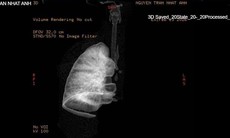 Gắp mảnh nhựa sắc nhọn, cứu bé 7 tuổi xẹp hoàn toàn phổi trái