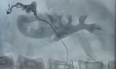 Bệnh viện 19-8 cấp cứu ca vỡ thận nguy kịch