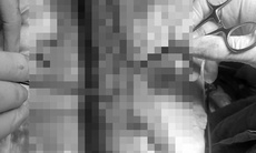 Dựng cây nêu vướng dây điện, người phụ nữ nguy cơ mất cẳng tay