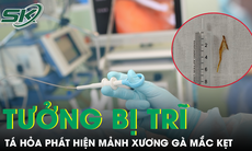 Tưởng bệnh trĩ tái phát, người đàn ông tá hỏa phát hiện mảnh xương gà mắc kẹt