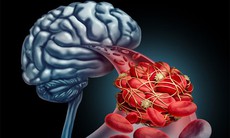 Dị dạng mạch máu: Dấu hiệu nhận biết và mức độ nguy hiểm không thể chủ quan