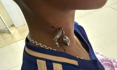 Móc câu cắm sâu vào cổ cậu bé