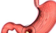 Viêm loét dạ dày dễ tái phát vào dịp cuối năm