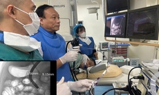 Sỏi ống mật chủ 'khủng' gây tắc mật nặng