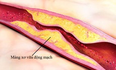 Các yếu tố nguy cơ đột quỵ và cách kiểm soát không dùng thuốc