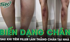 Cô gái 29 tuổi biến dạng hai cẳng chân sau khi tiêm filler làm thẳng chân tại nhà