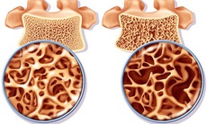 4 bí quyết giúp người lớn tuổi giảm nguy cơ loãng xương