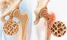8 cách tăng mật độ xương, giảm nguy cơ loãng xương và gãy xương