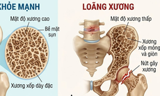 Phòng loãng xương cần hạn chế 5 loại thực phẩm này