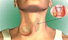 Nam giới mắc u tuyến giáp có nguy hiểm không?