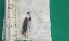 Phẫu thuật lấy dị vật lò xo bút bi 'ngủ quên' 13 năm trong vùng thái dương