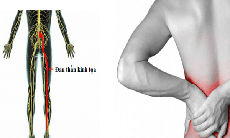 Vitamin và khoáng chất nào tốt cho người đau thần kinh tọa?