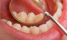 Ngoài thuốc lá, yếu tố nào làm tăng nguy cơ ung thư khoang miệng?